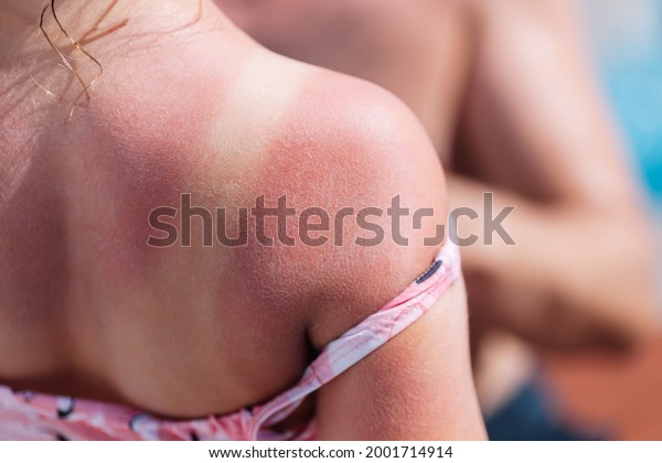 the red back of a\
girl with a sunburn and white lines from a swimsuit with a hotel\
pool on the background.