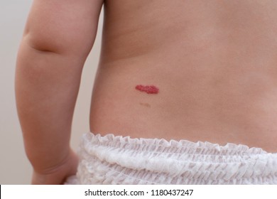 Red Birth Mark On The Baby Back, Over The Hip 