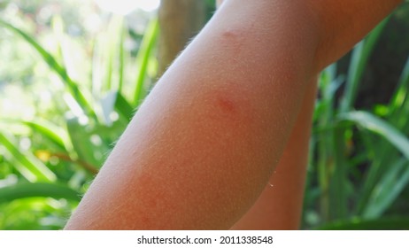 Red Bite Mark On The Leg. Itching And Inflammation. Scratch The Wound With Your Hand.