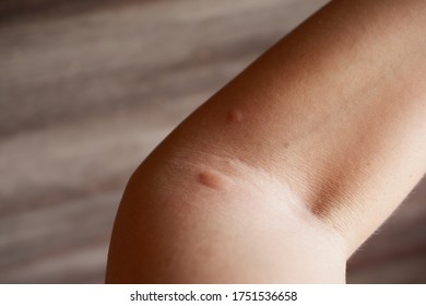 Red Blisters On Arm After Fire Ant Bite