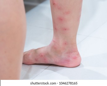 Red Blisters On A Girl's Legs After Ants Bite (Solenopsis Geminata ,tropical Fire Ant ).