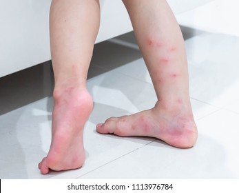 Red Blisters On A Girl's Legs After Ants Bite (Solenopsis Geminata ,tropical Fire Ant ).