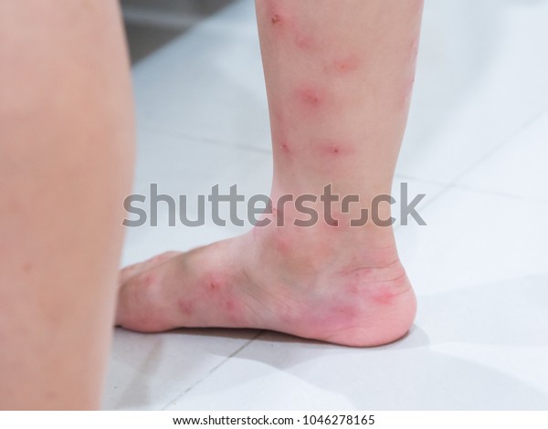 Red blisters on a girl\'s legs after\
ants bite (Solenopsis geminata ,tropical fire ant\
).