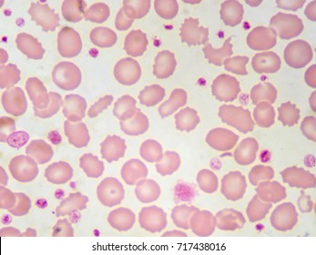 Red Blood Cells Platelet Blood Smear Stock Photo 717438016 | Shutterstock