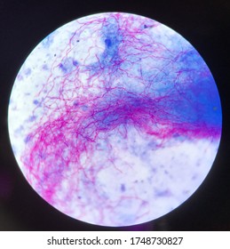 Rote verzweigende Mycobacterium tuberculosis auf blauem Hintergrund in modifizierten, schnellen Bakterienstreichern.Findet mit Mikroskop-Laborhintergrund.