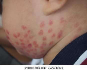 Red Burn Spot Or Scab On The Face Skin And Cheek, After Pulsed Dye Laser Treatment Removal Type Of Port Wine Stain Or Naevus Flammeus Birthmark In Little Child Boy.