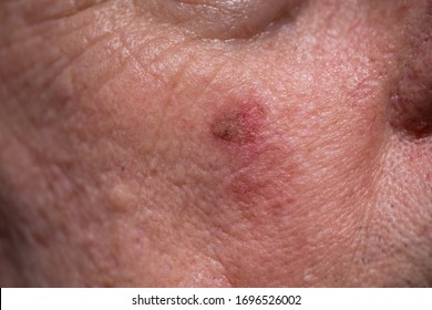 Rote, krustende Läsionen einer aktinischen Keratose oder Sonnenflecken auf sonnengeschädigter Haut auf der Wange unter dem rechten Auge eines Mannes. Dies kann mit Kryochirurgie oder bestimmten Salben behandelt werden