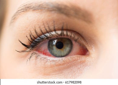 Red Eye For Allergy