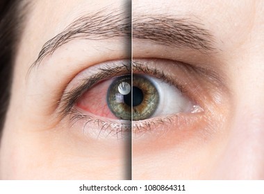 Red eye before and after treatment