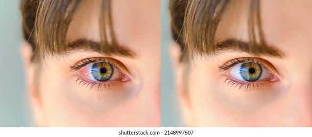 Red eye before and after treatment. Tired eyes and contact lenses. Close up. Dry eye before and after the use of eye drop. - Shutterstock ID 2148997507