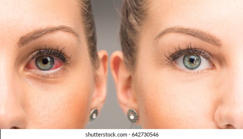 Red eye before and after the use of eye drop