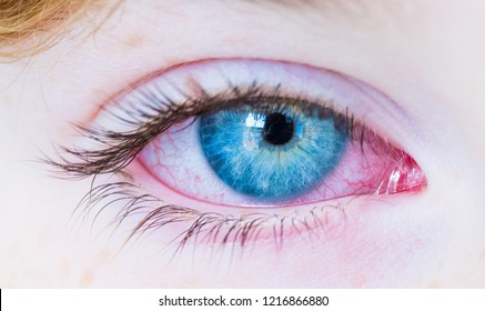 Red eye. Closeup of irritated red bloodshot eye, red and irritated human eye