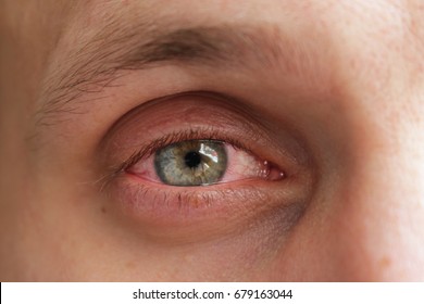 Red Eye Conjunctivitis