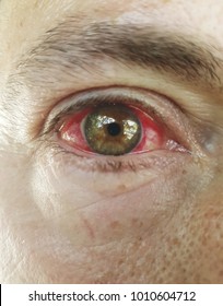 Red eye following chemical burn, eye irritation. Medical background.