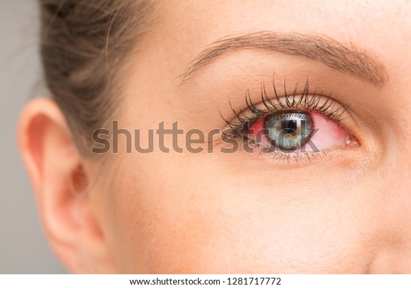 Red eye for irritation\
of the sclera