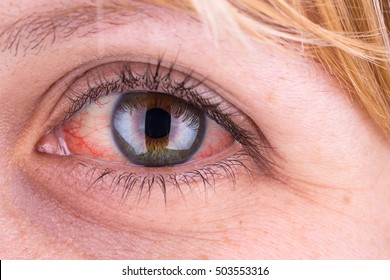 Red eye of a woman