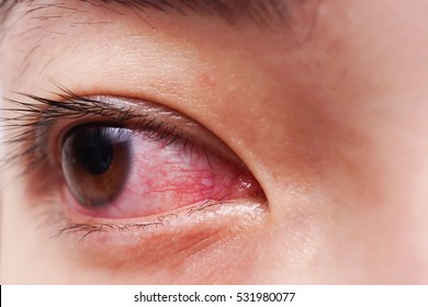 Red eye of woman , conjunctivitis eye or after cry