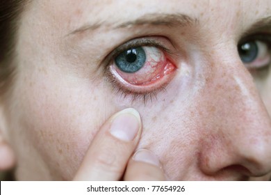 Red Eyes After Hay Fever Attack