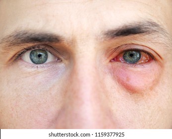 Red Eyes. Allergy. Close Up Of Wide Open Red And Irritated Human Eye