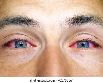 Red eyes. Allergy. Close up of wide open red and irritated human eye