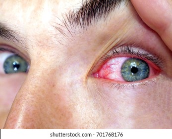 Red eyes. Allergy. Close up of wide open red and irritated human eye