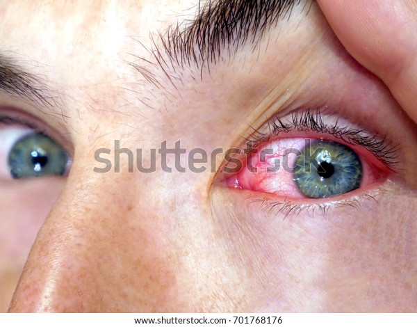 Red Eyes Allergy Close Wide Open Stock Photo (Edit Now) 701768176