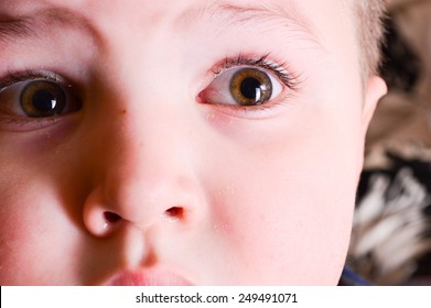 Red Eyes Of A Child. Boy With Conjunctivitis. Little Boy With Having Spring Allergy. Fear Of The Child