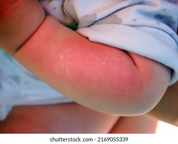 Red Hand Kid Baby Skin Close Up Sunburn From Sun. Peeling Of The Skin On The Arm Of A Child