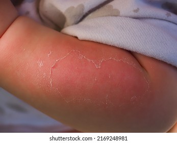 Red Hand Kid Baby Skin Close Up Sunburn From Sun. Peeling Of The Skin On The Arm Of A Child