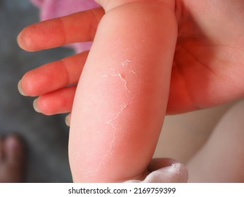 Red Hand Kid Baby Skin Close Up Sunburn From Sun. Peeling Of The Skin On The Arm Of A Child