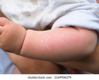 Red Hand Kid Baby Skin Close Up Sunburn From Sun. Peeling Of The Skin On The Arm Of A Child