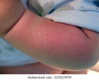 Red Hand Kid Baby Skin Close Up Sunburn From Sun. Peeling Of The Skin On The Arm Of A Child