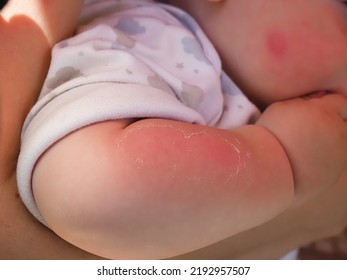 Red Hand Kid Baby Skin Close Up Sunburn From Sun. Peeling Of The Skin On The Arm Of A Child