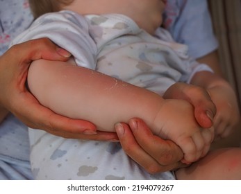 Red Hand Kid Baby Skin Close Up Sunburn From Sun. Peeling Of The Skin On The Arm Of A Child