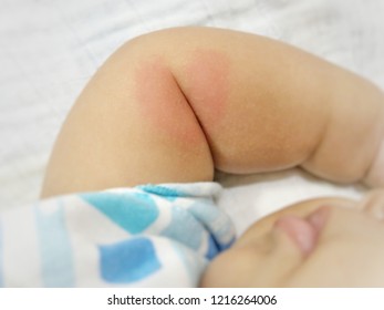 Red Heart Shape Spot On Child’s Arm From Mosquito Bite, Blur Concept Picture Focusing Only Red Spot