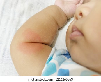 Red Heart Shape Spot On Child’s Arm From Mosquito Bite