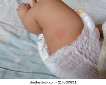 Red heart shape spot on child's legs from mosquito bite.