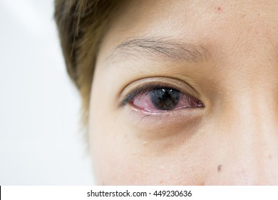 Red Infected Eye