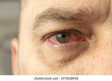 Red and inflamed eye close-up. Patient's red eye. Allergic reaction