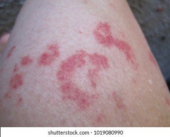 Skin Allergy Images, Stock Photos & Vectors | Shutterstock