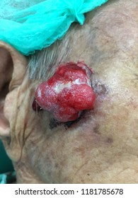 Red Mass Lesion On Cheek  Like  Skin Cancer  Or Squamous Cell Carcinoma 