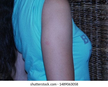 Red Mosquito Bite On Arm