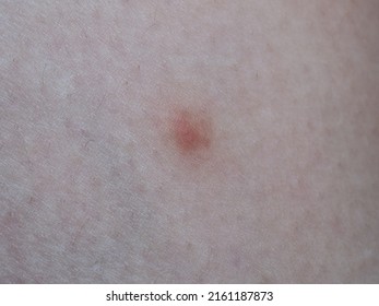 Red Mosquito Bite On Human Skin Stock Photo 2161187873 | Shutterstock