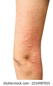 Red Rash On Asian Woman Right Arm Skin From Insect Bites Allergy Isolated On White Background,clipping Path	