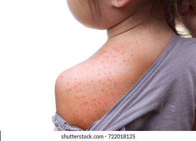 赤ん坊の背中の赤い発疹 インバンタム Roseola Invantum 写真素材 Shutterstock