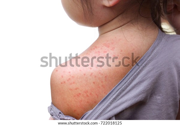 赤ん坊の背中の赤い発疹 インバンタム Roseola Invantum の写真素材 今すぐ編集