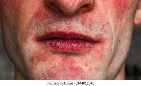 Red Rash On The Face, Red Spots Around The Mouth, Allergic Disease