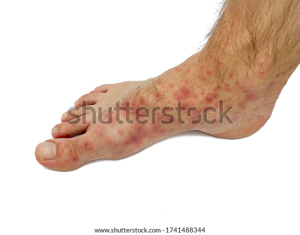 Red Rash On Feet Male Image Stock Photo 1741488344 | Shutterstock