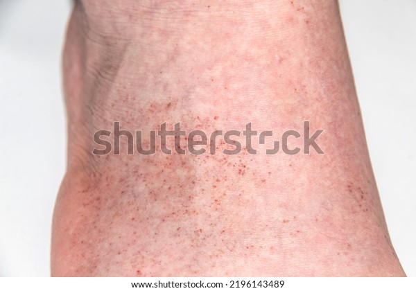 red-rash-on-foot-male-against-stock-photo-2196143489-shutterstock