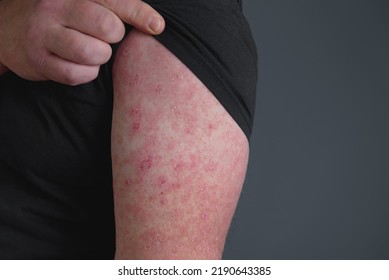 Red rash on forearm. Hand afflicted Ð²ermatophytosis on skin. Erysipelas - Shutterstock ID 2190643385